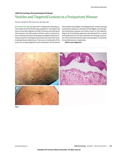 Vesicles And Targetoid Lesions In A Postpartum Woman Dermatology