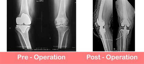Revision Total Knee Replacement Dr Shekhar Agarwal