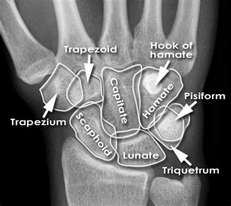 Pin By Meghakrishnan On Radiography Wrist Anatomy X Ray Anatomy