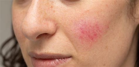 Rosacea Symptoms Causes And Treatment