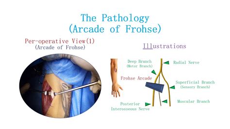 Posterior Interosseous Nerve Syndrome Arcade Of Frohse Youtube
