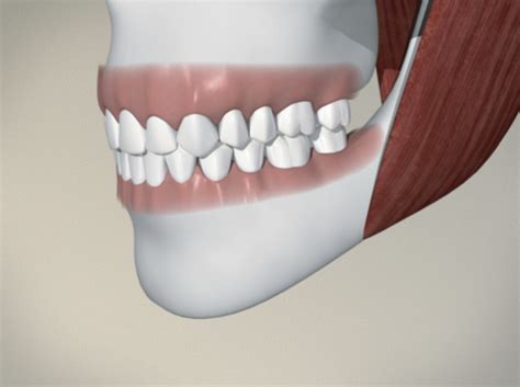 Wisdom Teeth Nish Dental Clinic