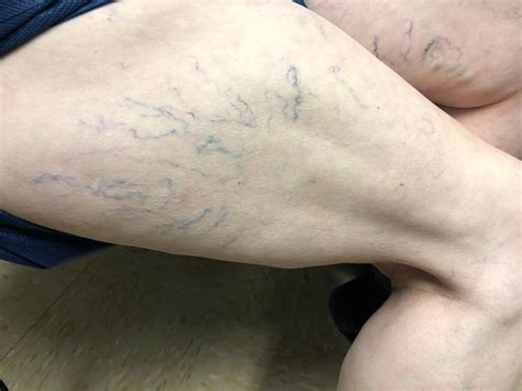 Why Do I Have Bulging Blue Veins On My Leg