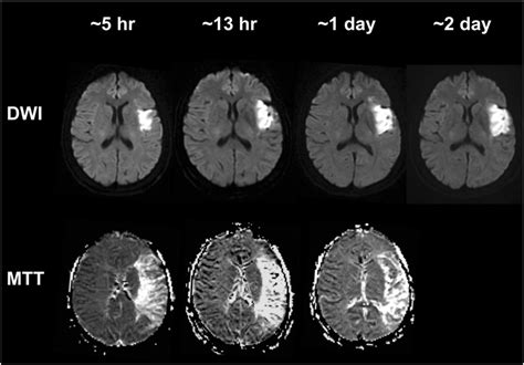 Serial Mri Diffusion And Perfusion Mean Transit Time Images Of Patient