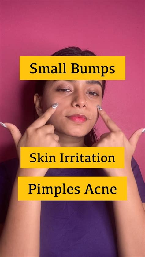 Natural Home Remedy To Reduce Pimples Acne Skin Irritation And Small