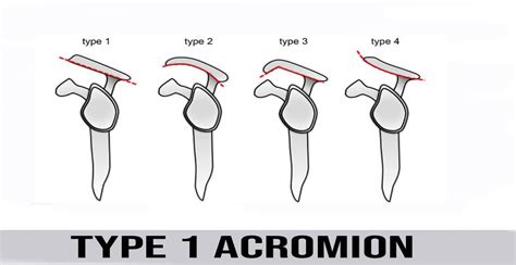 Acromion Types