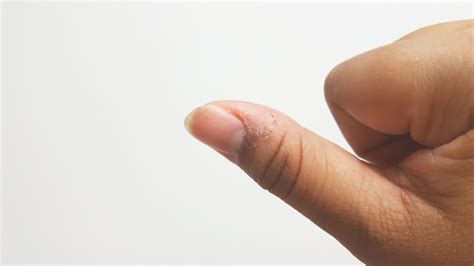 Zanokcica przyczyny i leczenie zapalenia wału paznokcia Zdrowie Wprost