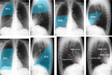 Lung Anatomy Wikiradiography