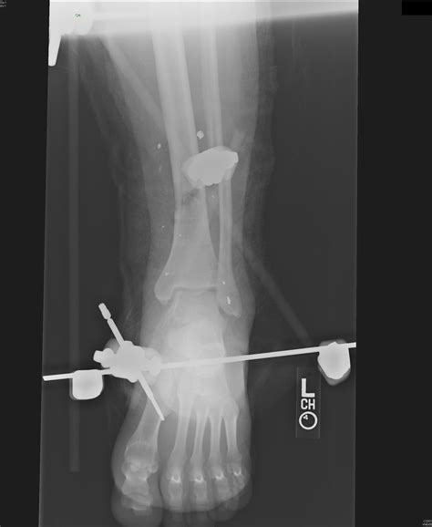 It is an alternative to internal fixation, where the components used to provide stability are positioned entirely within the patient's body. Wheeless' Textbook of Orthopaedics
