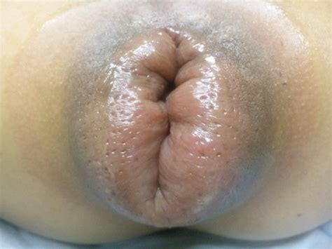 Suction Anus Photo Album By Infiniteheart