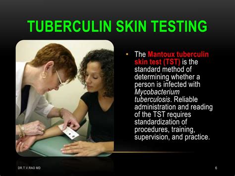 Ppt Tuberculin Skin Testing Mantoux Tuberculin Skin Test Powerpoint