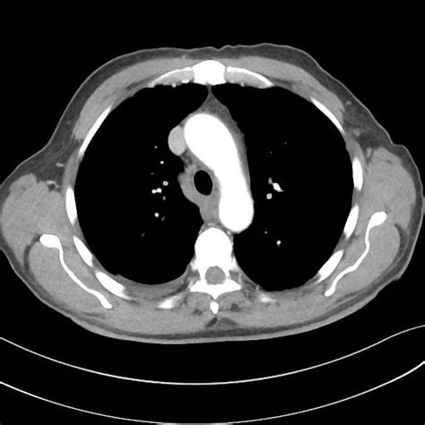 It rarely occurs as a localized tumor that might be surgically resectable. Pleural Epithelioid Mesothelioma