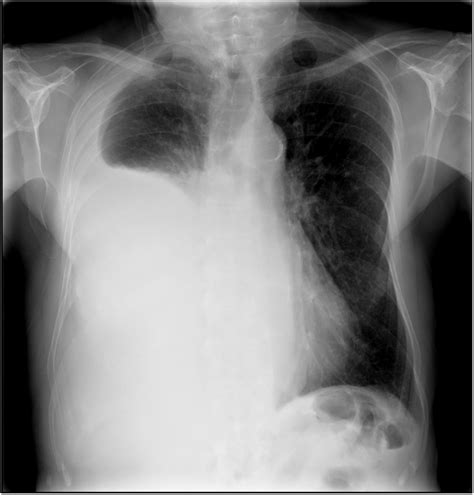 Chest X Ray In Postero Anterior Projection Where A Massive Hydrothorax
