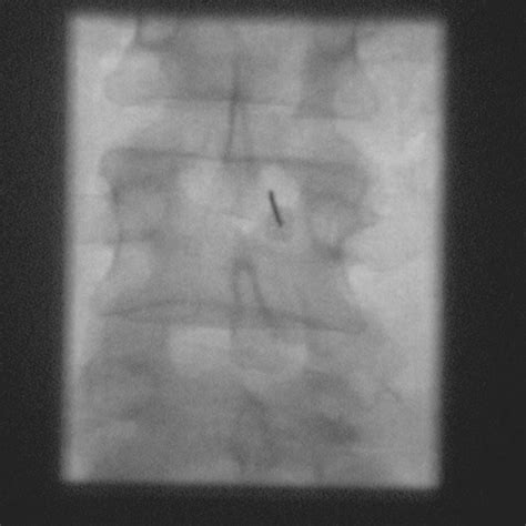 Lumbar Puncture X Ray Medical Sharp Grossmont Hospital San Diego La
