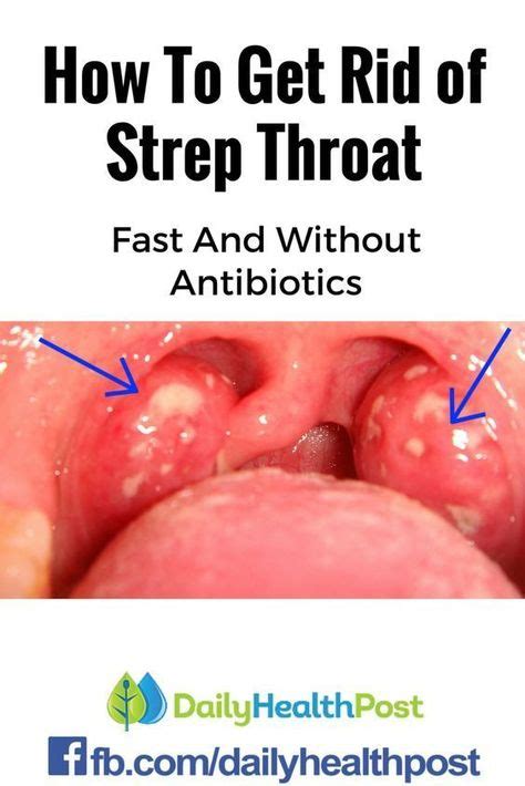 Ultimate Guide To Combat Warning Signs Of Strep Throat Eval Pulch