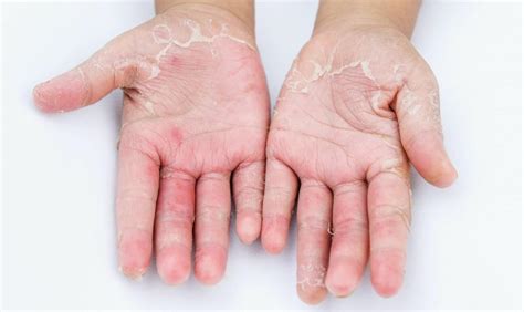 Symptoms Of Contact Dermatitis Ulrike Ziegner Md Phd Allergist