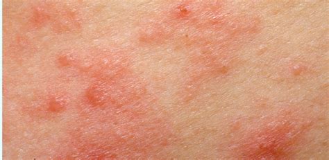 Psoriasis Or Eczema Psoriasisspeaks