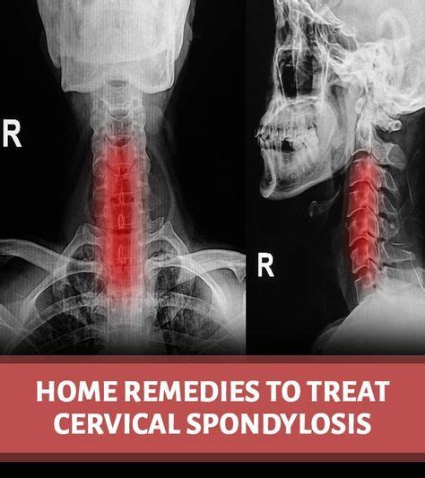 Cervical Spondylosis Symptoms Causes Natural Treatments Exercises Tips Cervical