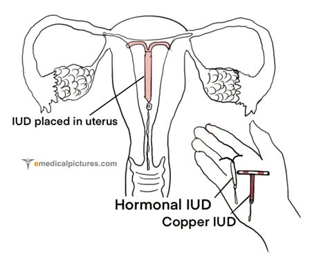 Iud Intrauterine Device Diagram And Images Medical Pictures And Images Updated