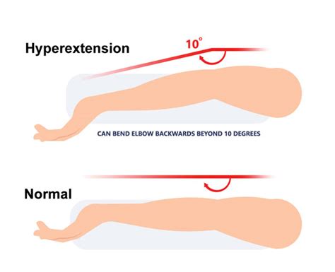 Elbow Hyperextension Injury Symptoms Causes And Treatment