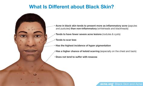 Treating Acne In Black Skin