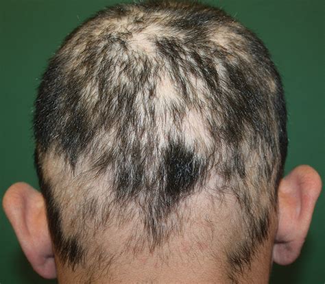 Alopecia areata, also known as spot baldness, is an autoimmune disease in which hair is lost from some or all areas of the body. Alopecia Areata | IntechOpen