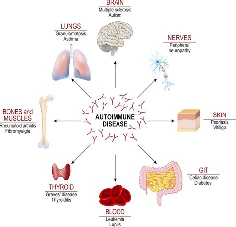 An Autoimmune Like Antibody Response Is Linked With Severe Covid 19