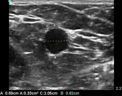 Ultrasound Of Basilic Vein With Measurement Of Anterior To Posterior