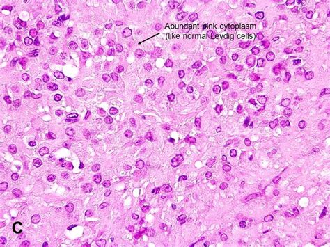 American Urological Association Leydig Cell Tumor