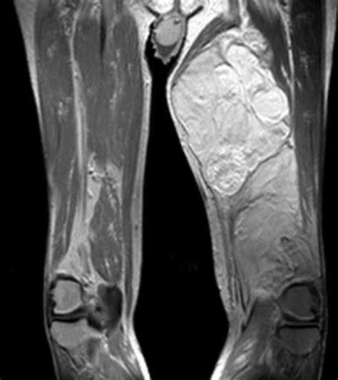 Liposarcoma Of The Thigh Radiology Case