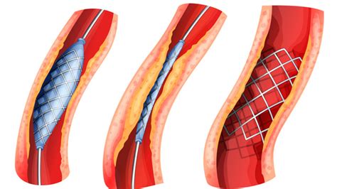 Angioplasty Heart Attack Diagnosis Test Heart Tests Heart