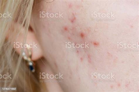 Close Up Photo Of Nodular Cystic Acne Skin Stock Photo Download Image