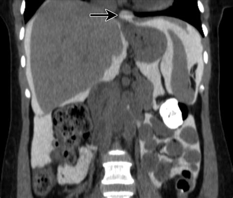 Complications Of Continuous Ambulatory Peritoneal Dialysis Radiographics