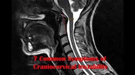 Craniocervical Instability Symptoms The 8 You Need To Know 2023