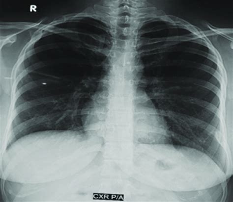 Expansile Sclerotic And Lytic Lesions Involving The 2 Nd And 3 Rd Ribs