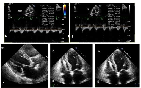 Cureus Differentiating Pseudo Versus True Aortic Stenosis In Patients