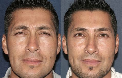 Mens Skin San Diego Ca Cosmetic Laser Dermatology
