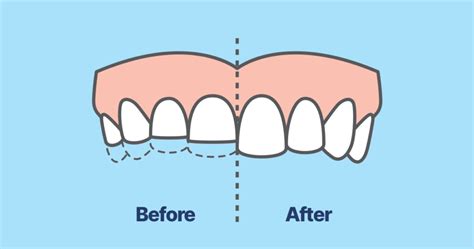 How To Fix Teeth Grinding On Point Dental