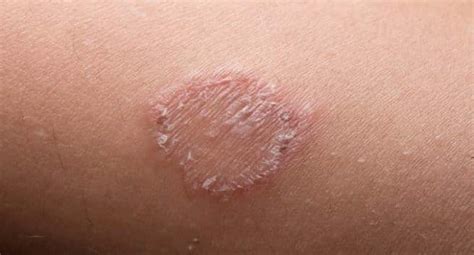 Troubled By Ringworm 5 Natural Remedies To Cure The Common Fungal
