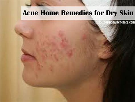 Acne Home Remedies For Dry Skin