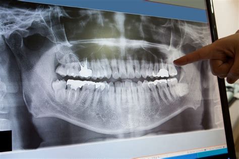 Why Dental X Rays Are Important