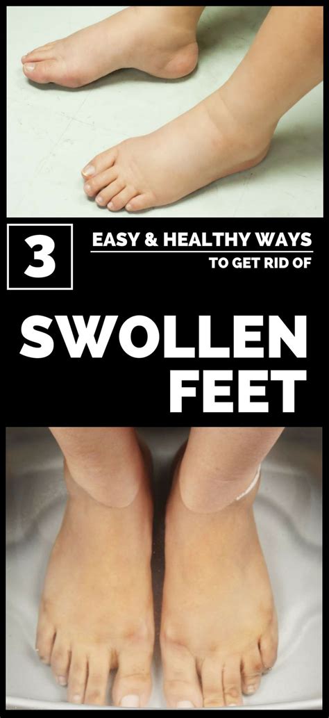 3 Easy And Healthy Ways To Get Rid Of Swollen Feet