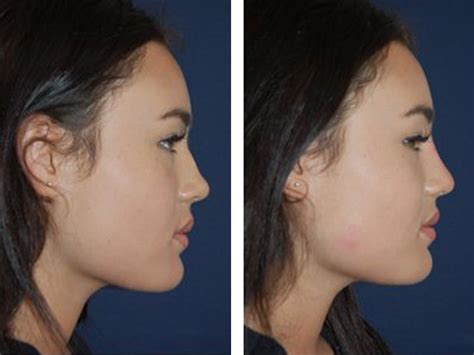 Non Surgical Nose Job Rhinoplasty Costs In London 111