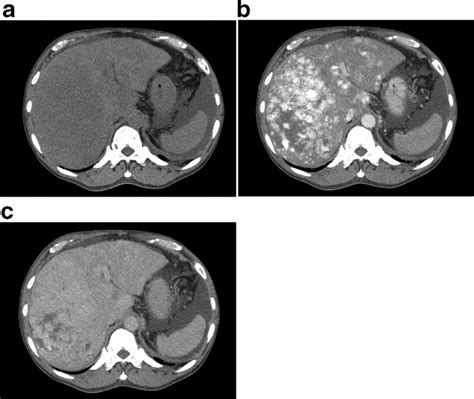 Contrast Enhanced Computed Tomography Ct A Precontrast B Early