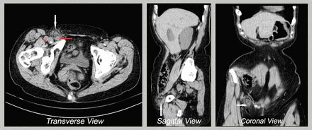 A Case Of De Garengeot Hernia And Literature Review BMJ Case Reports