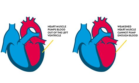 Heart Failure Symptoms Causes And Treatment Patient Info