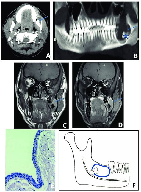 A−e Dentigerous Cyst Axial Postcontrast A And Panoramic