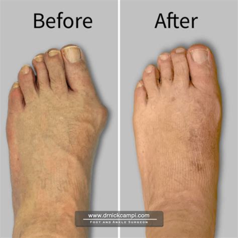 Dr Nicholas Campitelli Akron Podiatrist Bunion Surgery Dr