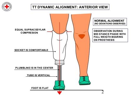 Transtibial Dynamic Alignment Prosthetic Device Prosthetic Leg
