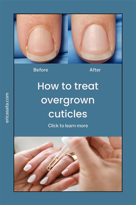 12 Easy Quick Tips To Treat And Prevent Peeling Cuticles Artofit